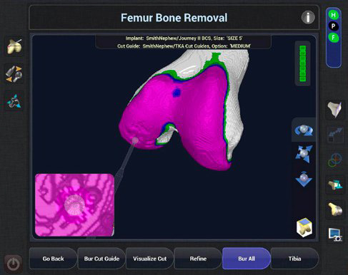 robotic knee replacement, robotic surgery