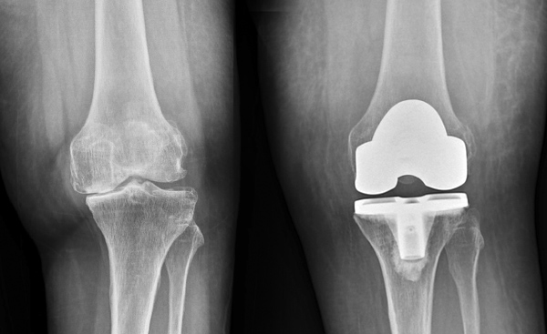 Best Knee replacement hospital, knee replacement hospital in chennai