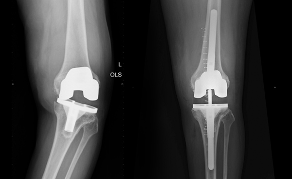 knee replacement surgery near me, best ortho hospital in chennai