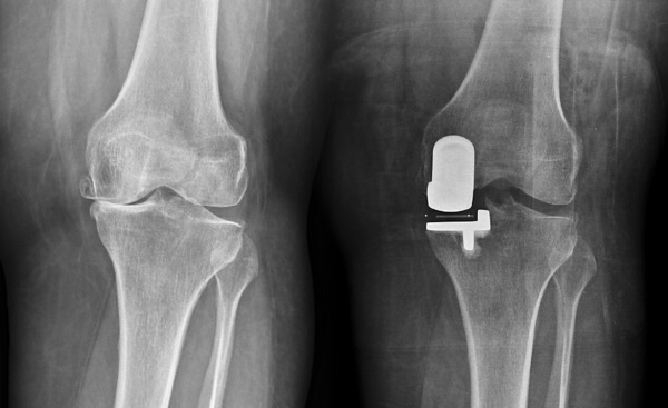 knee replacement hospital in chennai, knee replacement hospital near me