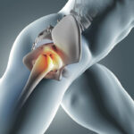 best ortho hospital in chennai, orthopedic surgery, Joint Replacement hospital