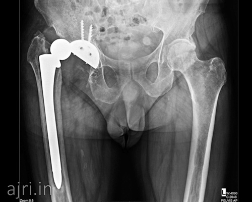 hospital for hip revision surgery, hip replacement hospital near me