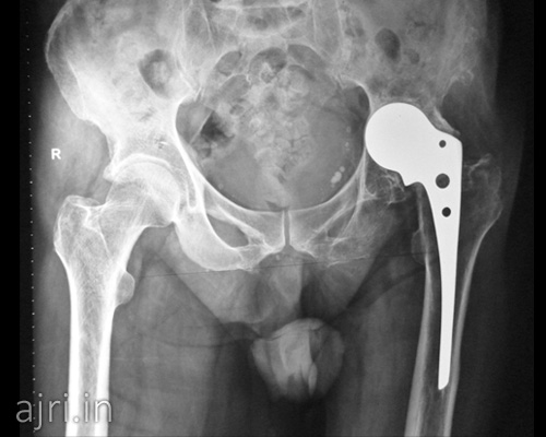 hip replacement hospital near me, hip replacement hospital