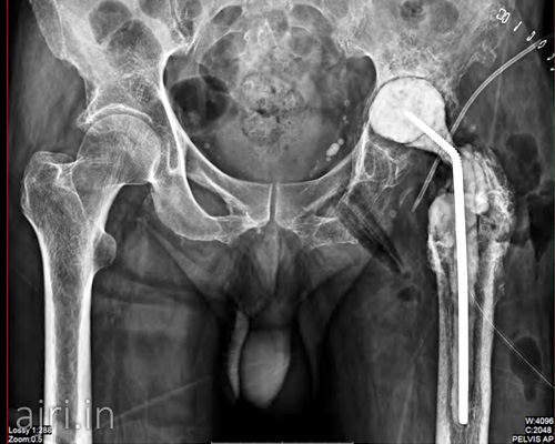 complex hip revision surgery, infected hip revision