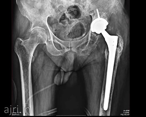 hip replacement hospital in chennai, best hip replacement hospital in chennai