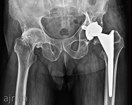 hip replacement hospital in chennai, best hip replacement hospital in chennai