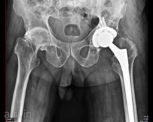 hospital for hip revision surgery, hip replacement hospital near me