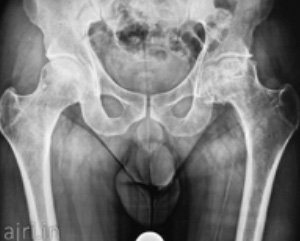total hip arthroplasty, hip replacement surgery