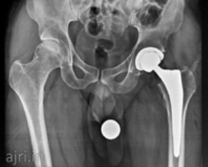 best hip replacement surgeon in chennai, total hip replacement