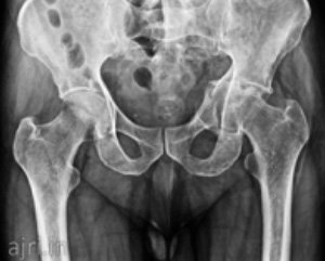 hip replacement, Best Total Hip replacement hospital Chennai