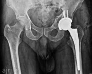 Hip Replacement hospital, Best arthritis hospital