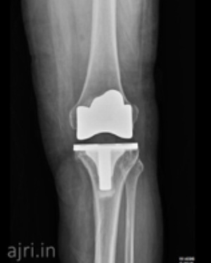 total knee replacement surgery in chennai, knee replacement surgery