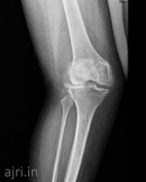 total knee arthroplasty, best knee replacement hospital in chennai