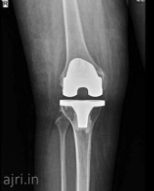 total knee replacement, total knee replacement surgery in chennai